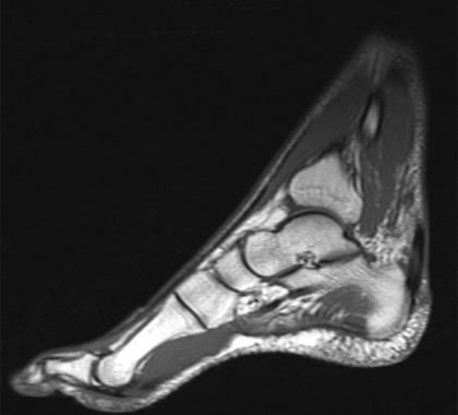 MRI of my left foot